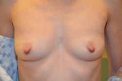 Before and After Breast Augmentation Valparaiso, IN