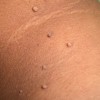 skin tags